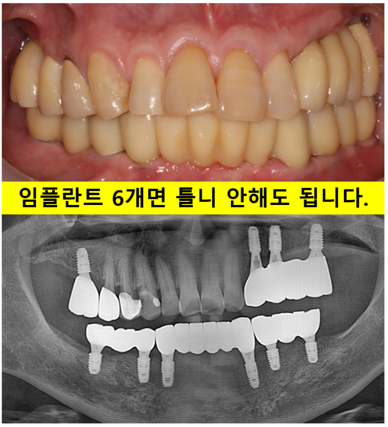 아래 어금니 임플란트 6개면 틀니를 안써도 됩니다.  치주염 전문 착한치과. 치료기간/임시치아과정/후기/비용. 관련 이미지 1
