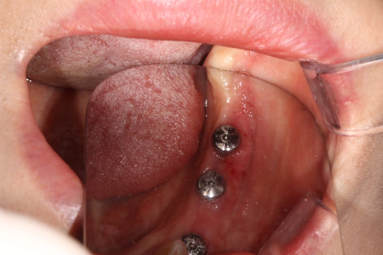 어금니 임플란트 주변 잇몸이식수술 - 저는 해야한다고 생각합니다. (feat. 대한치과의사협회 논문 + 치주과전문) 관련 이미지 22