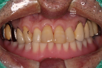 아래 어금니 임플란트 6개면 틀니를 안써도 됩니다.  치주염 전문 착한치과. 치료기간/임시치아과정/후기/비용. 관련 이미지 32