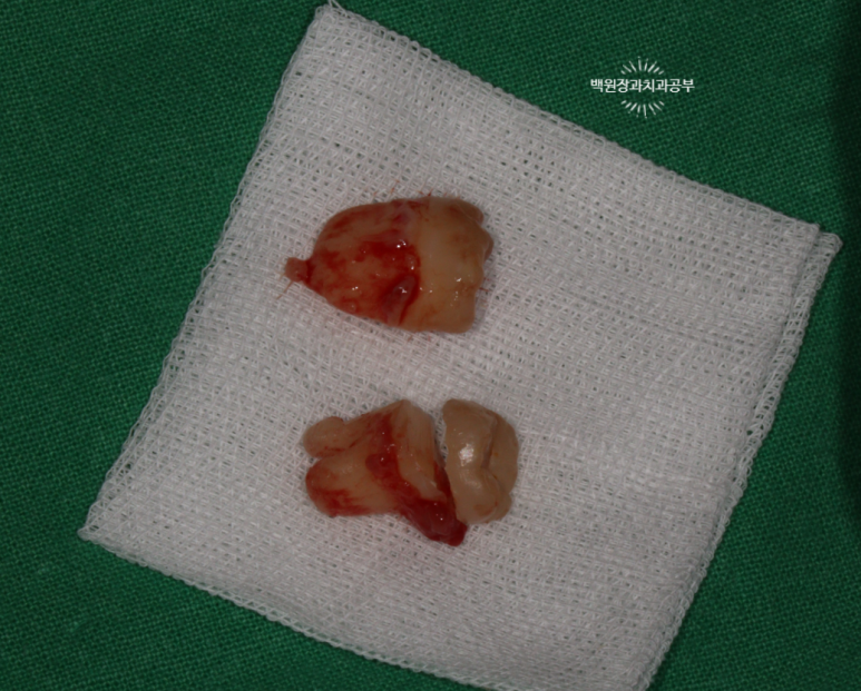 매복 사랑니 10분만에 뽑기! 치료과정/치료기간/비용/후기. 관련 이미지 7