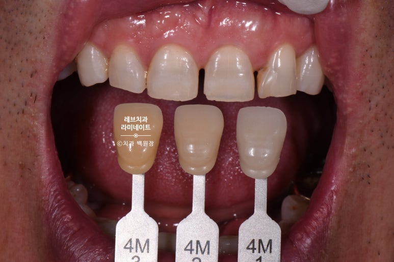 신사역 무삭제 라미네이트 : 레브네이트 내츄럴 최소삭제 비니어. 50대 앞니 벌어짐 비용/후기/얼굴사진. 관련 이미지 7