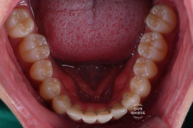 What About Laminates at Sinsa Station? Rev Dental Clinic’s Revnate. image 7