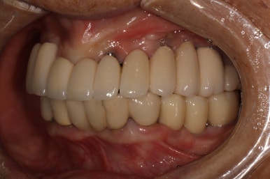 부분틀니를 오래써서 어금니가 아플 때, 아래턱 양쪽 어금니 임플란트 잘하는 강남임플란트치과 관련 이미지 24
