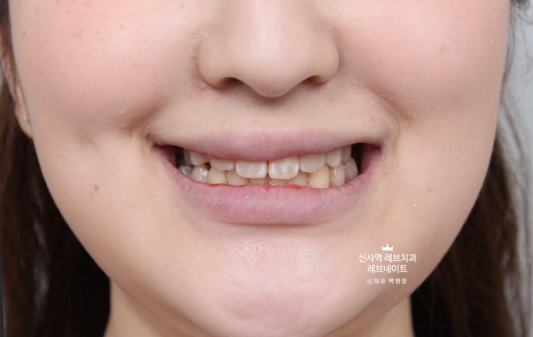 신사역 치과. 아나운서 면접 전 앞니 벌어진 공간을 라미네이트로만 해결할 수 있었던 사연.. 관련 이미지 23
