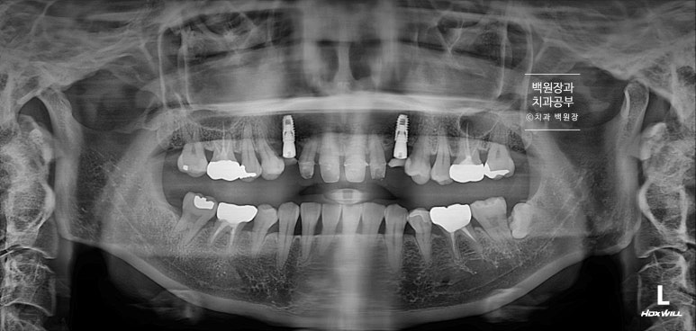 크라운 앞니 충치로 냄새가 나요 - 최소한의 임플란트와 씌우는 치료. 치료과정/기간/비용. 관련 이미지 10