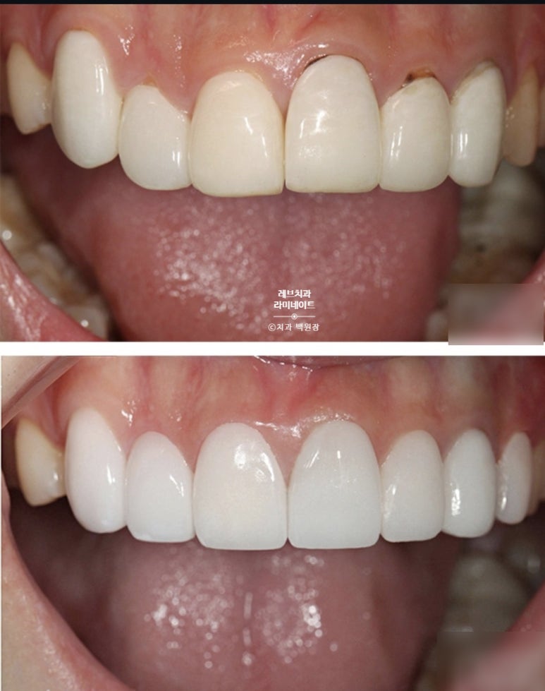 신사역 퍼스널컬러 맞춤 치과. 전담 세라미스트가 앞니 크라운과 라미네이트를 만들어 드립니다. 관련 이미지 8