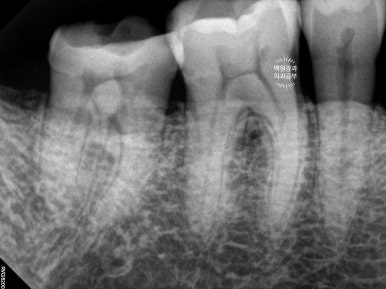 뿌리만 남은 앞니, 어금니가 없어 교합이 무너진 증례. 흡연자의 전체 오스템BA임플란트 재건증례. 치료과정/치료기간/비용/후기. 관련 이미지 11