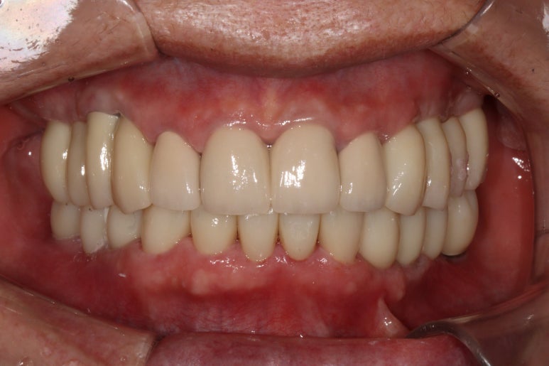 어금니 여러개가 없어요. 전체 임플란트와 앞니 크라운을 통한 완벽한 재건!! 치료과정/치료기간/비용/후기. 관련 이미지 27