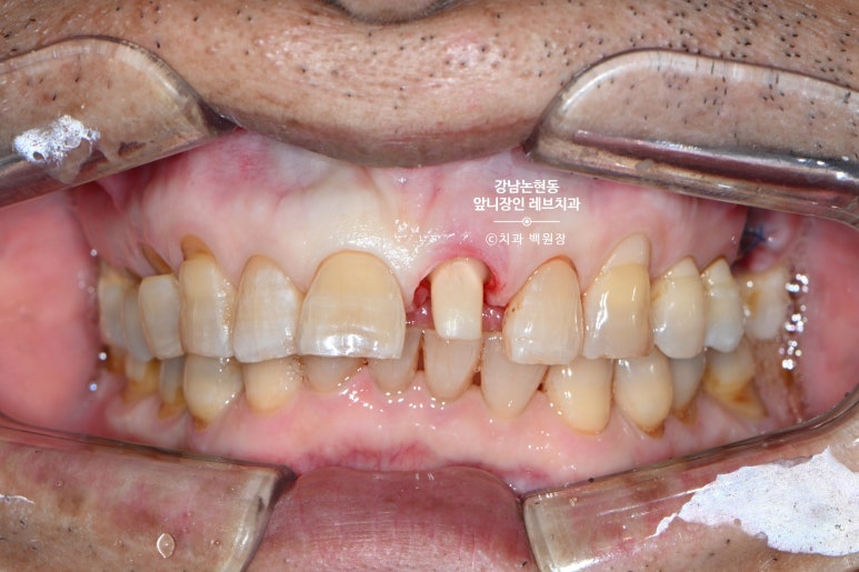 강남논현동치과 60대 치아부러짐 - 신경치료하고 기둥심고 앞니 크라운 잘하는곳! 가격/과정/후기/부작용. 관련 이미지 10