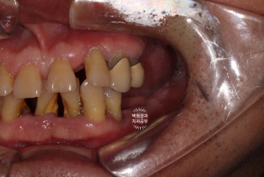 임플란트장인의 마음으로 8개월간 전체임플란트 완성. 치주과 전문의. 관련 이미지 5