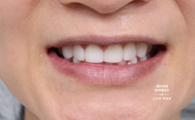 아래앞니 라미네이트도 무삭제로 가능한가요? 레브네이트 베이직 가격/비용/후기/추천. 관련 이미지 17