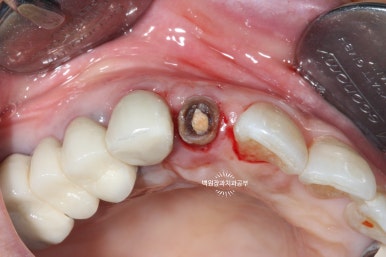 외과적 정출술 (surgical extrusion) - 치아를 살리는 마지막 방법. 치료과정/치료기간/비용/사진. 관련 이미지 9