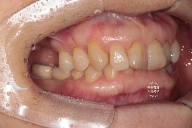 삐뚤빼뚤 앞니 세로 금  - 신경치료 없이 지르코니아 크라운으로. 상악동뼈이식술 임플란트. 관련 이미지 3
