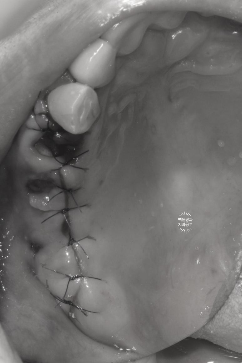 60대 임플란트 주변에서 고름이 나와요. 실패한 임플란트 제거 후 재수술. 덴티움 뼈이식재를 사용한 치조골 이식술. 관련 이미지 7