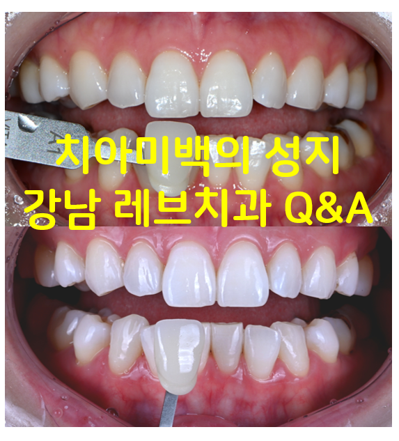 강남 치아미백 성지 레브치과. 가격/비용/부작용/전후사진. 관련 이미지 1