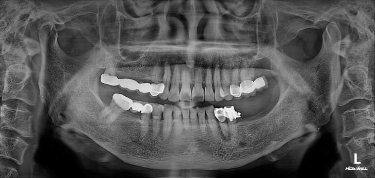 어금니 임플란트 주변 잇몸이식수술 - 저는 해야한다고 생각합니다. (feat. 대한치과의사협회 논문 + 치주과전문) 관련 이미지 6