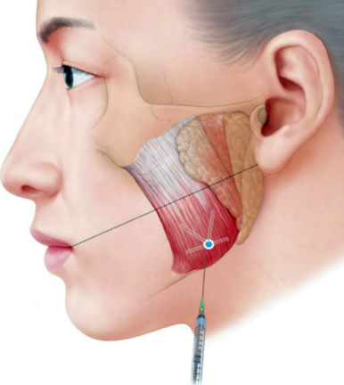 이갈이보톡스를 치과에서 치료받아야 하는 이유. 코어톡스 가격 주기 부작용 정보. 관련 이미지 1