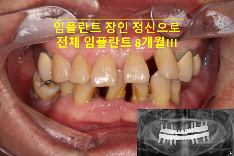 임플란트장인의 마음으로 8개월간 전체임플란트 완성. 치주과 전문의. 관련 이미지 1