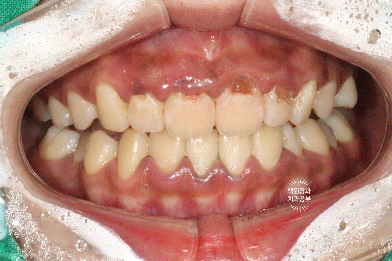 잇몸치료와 앞니 레진치료. 3년이 지난 모습 궁금하지 않으신가요? 3M 레진쓰는 치과. 후기/시간/과정/비용. 관련 이미지 2