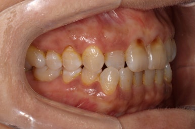 치아크랙 (금간 치아)의 찌릿한 통증 - 발치하지 않고 살려보기. 원인/진단/치료과정/비용/기간. 보존과전문의 치과. 관련 이미지 4