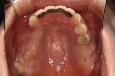 전세계 1위 스트라우만 임플란트를 사용한 어금니 기능회복과 앞니 지르코니아 크라운 증례. 관련 이미지 8