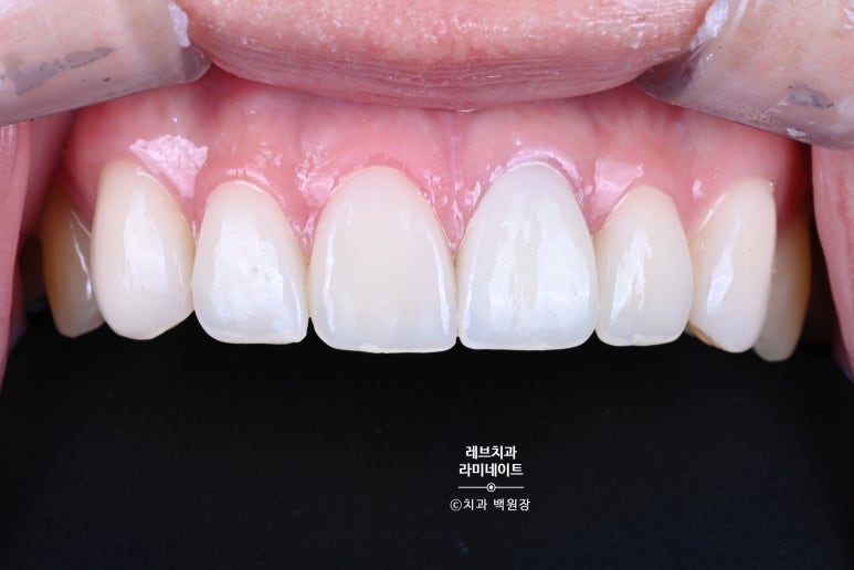 레브네이트 엑스퍼트 ; 유튜버가 선택한 앞니 라미네이트. 앞니 레진 벌어짐을 자연스러우면서 화사하게 바꿔봅시다. 신사역 치과. 치료후기/비용/가격. 관련 이미지 14