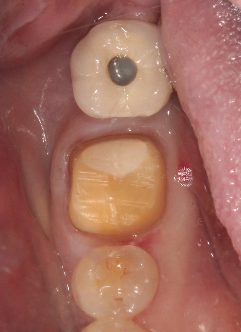 어금니 보철물이 떨어졌어요. 골드인레이 탈락 후 지르코니아 크라운으로 치료. 충치치료과정/치료기간/비용/후기. 관련 이미지 9