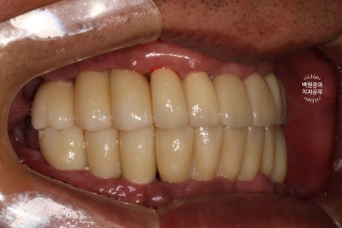 만성치주염으로 인해 아주 좁아진 잇몸뼈에 광범위한 뼈이식 + 전체임플란트. 신사 레브치과. 관련 이미지 54