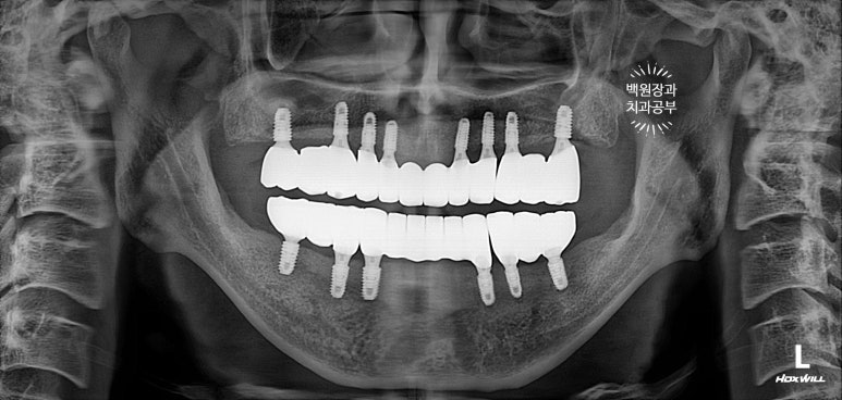 만성치주염으로 인해 아주 좁아진 잇몸뼈에 광범위한 뼈이식 + 전체임플란트. 신사 레브치과. 관련 이미지 58