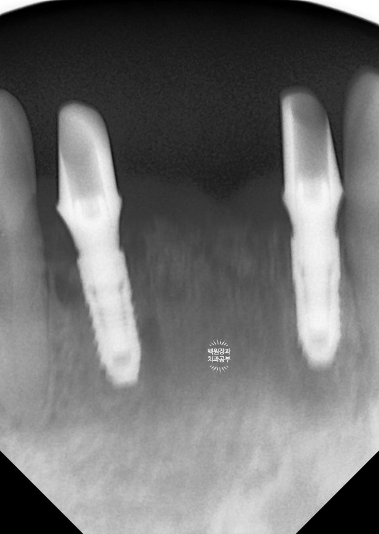 Seoul Sinsa Station [Lev Dental Clinic] For chronic periodontitis, extract the lower front teeth and make the crown look even more real than the real thing with an implant. image 10