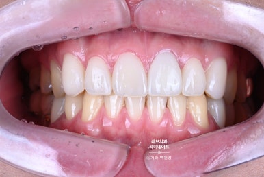 레브네이트 엑스퍼트 ; 유튜버가 선택한 앞니 라미네이트. 앞니 레진 벌어짐을 자연스러우면서 화사하게 바꿔봅시다. 신사역 치과. 치료후기/비용/가격. 관련 이미지 18