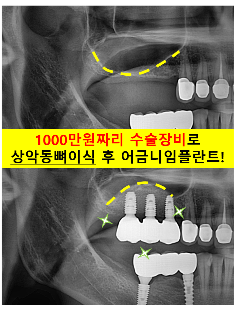 부분틀니 대신 어금니 임플란트를 만들어드립니다. 40대 어금니 상악동 뼈이식 임플란트. 치료기간/비용/과정. 관련 이미지 1