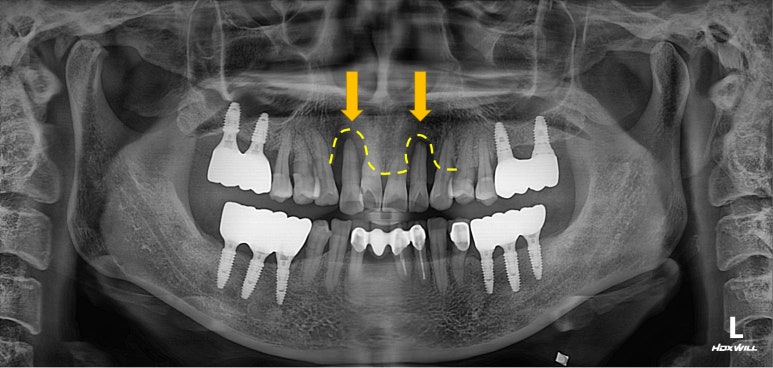 앞니가 풍치로 흔들거려요. 심한 치주염인데 임플란트 가능할까요? 치료과정/치료기간/비용/성공후기. 신금호역 치과 추천. 관련 이미지 6