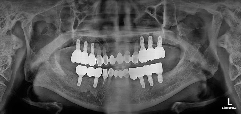 잇몸 염증 고름이 심했던 부위 - 만성치주염 진단하고 임플란트로 깔끔하게 치료! 신사역 치과 관련 이미지 25