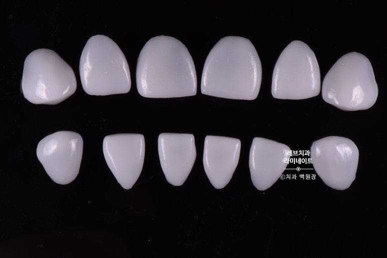 레브네이트 마스터 ; 예비신랑 앞니 무삭제라미네이트. 신사역 치과. 치료후기/비용/가격. 관련 이미지 2