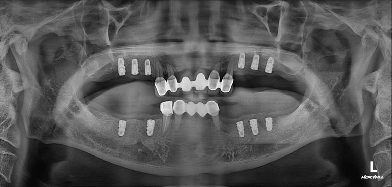 잇몸 염증 고름이 심했던 부위 - 만성치주염 진단하고 임플란트로 깔끔하게 치료! 신사역 치과 관련 이미지 18