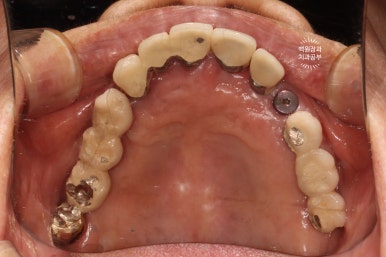 스트라우만 임플란트로 이뽑고 바로심는치과 - 믿고 사용하는 세계 1위 스위스 임플란트 회사. 관련 이미지 11