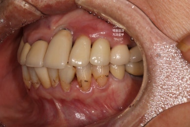 스트라우만 임플란트로 이뽑고 바로심는치과 - 믿고 사용하는 세계 1위 스위스 임플란트 회사. 관련 이미지 38