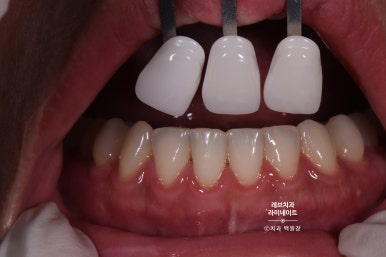 레브네이트 베이직. 치아미백과 치아교정을 한번에! 치아삭제 사진 있음. 신사역 치과 앞니라미네이트 모델/비용/후기. 관련 이미지 9