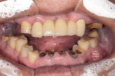 뿌리만 남은 앞니, 어금니가 없어 교합이 무너진 증례. 흡연자의 전체 오스템BA임플란트 재건증례. 치료과정/치료기간/비용/후기. 관련 이미지 2