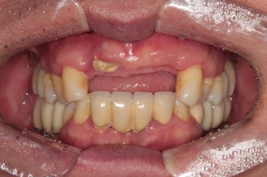 앞니가 풍치로 흔들거려요. 심한 치주염인데 임플란트 가능할까요? 치료과정/치료기간/비용/성공후기. 신금호역 치과 추천. 관련 이미지 25