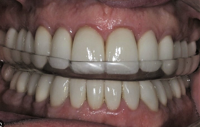 이갈이보톡스를 치과에서 치료받아야 하는 이유. 코어톡스 가격 주기 부작용 정보. 관련 이미지 10