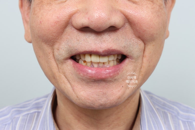 신사역 앞니 임플란트 잘하는 레브치과. 가격/비용/사진/후기. (프로포폴 수면가능) 관련 이미지 15