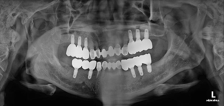 잇몸 염증 고름이 심했던 부위 - 만성치주염 진단하고 임플란트로 깔끔하게 치료! 신사역 치과 관련 이미지 36