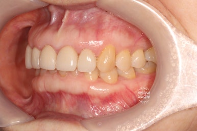 삐뚤빼뚤 앞니 세로 금  - 신경치료 없이 지르코니아 크라운으로. 상악동뼈이식술 임플란트. 관련 이미지 22
