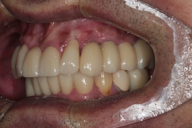 큰 어금니를 잃을 정도의 풍치를 앓으셨다면, 조속한 어금니 임플란트는 필수입니다. 관련 이미지 19