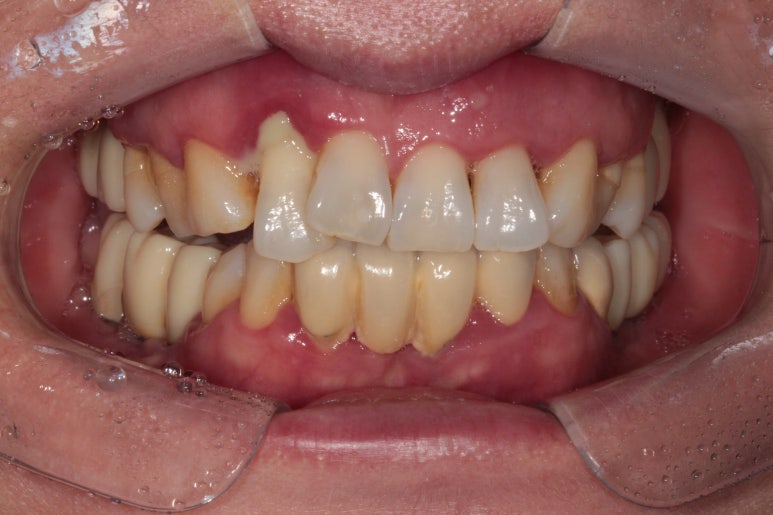 앞니가 풍치로 흔들거려요. 심한 치주염인데 임플란트 가능할까요? 치료과정/치료기간/비용/성공후기. 신금호역 치과 추천. 관련 이미지 2