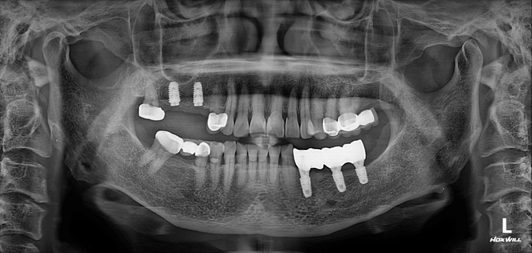 어금니 임플란트 주변 잇몸이식수술 - 저는 해야한다고 생각합니다. (feat. 대한치과의사협회 논문 + 치주과전문) 관련 이미지 28