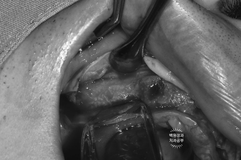 만성치주염으로 인해 아주 좁아진 잇몸뼈에 광범위한 뼈이식 + 전체임플란트. 신사 레브치과. 관련 이미지 23