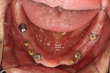 불편한 틀니를 아직도 쓰시나요? 전체 임플란트 치료비용/치료기간/치료과정. 관련 이미지 14